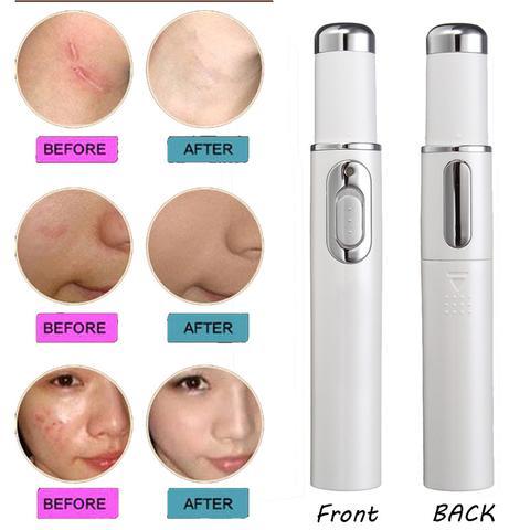 Blue Light Therapy Acne Laser Pen Soft Scar Wrinkle Removal Treatment Device Skin Care Beauty Equipment - Image 3